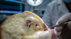 Caséum : les aliments à éviter pour dire adieu aux boules blanches et à la mauvaise haleine 2 Caséum : les aliments à éviter pour dire adieu aux boules blanches et à la mauvaise haleine